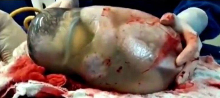 Εκπληκτικό βίντεο: Αυτό το μωρό γεννήθηκε μέσα στον αμνιακό σάκο!